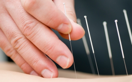 Acupuncture_1